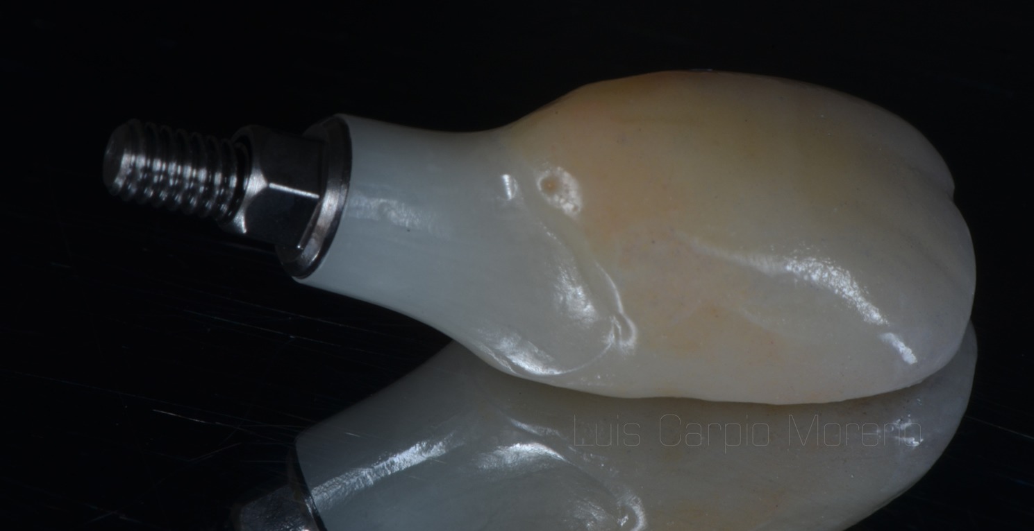 Implantologia implante dental