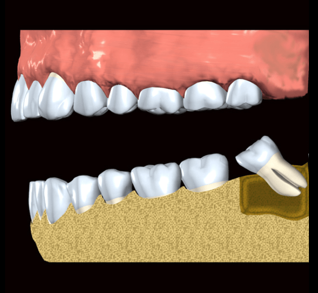 Extracciones de terceros molares o muelas del juicio